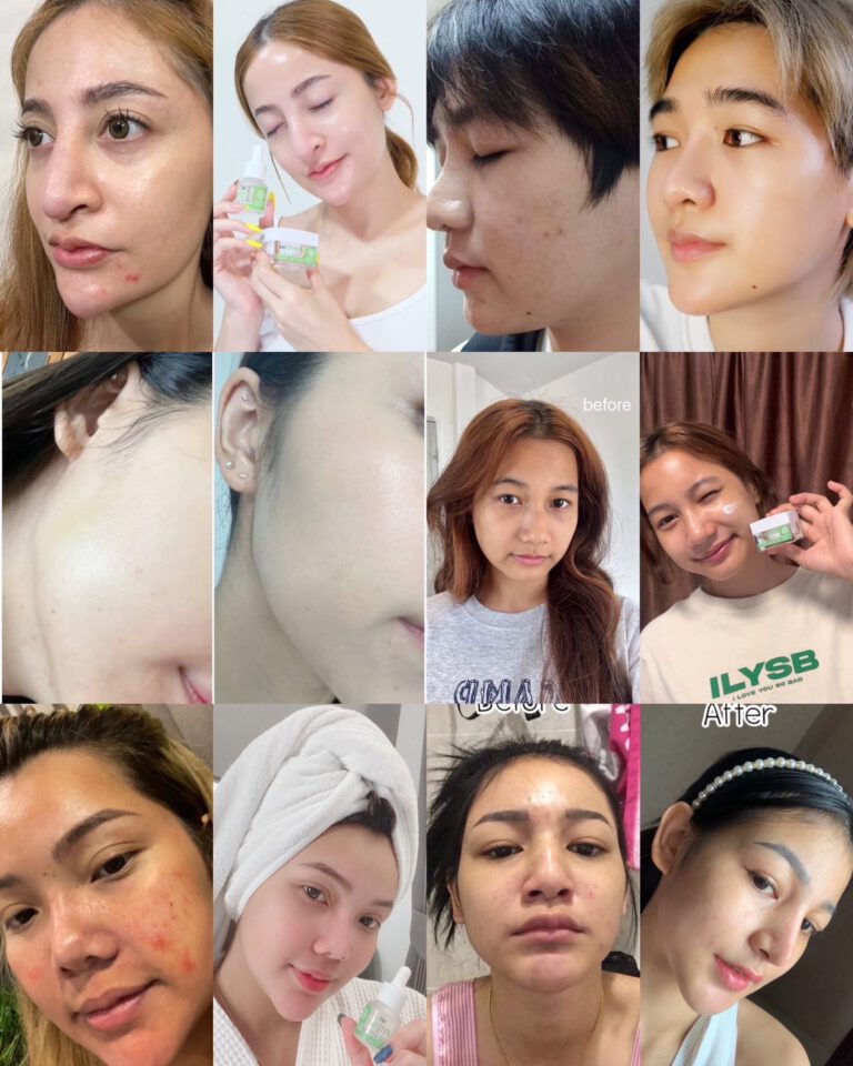 ครีม-เซรั่ม-สลายฝ้า-กระ-จุดด่างดำ -หน้าหมองคล้ำ-MH8Pitera รีวิว